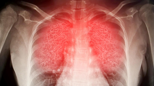 Lunge: Das SARS-CoV-2-Coronavirus kann jedes Organ befallen.  (Symbolbild) (Quelle: Getty Images / sompong_tom)