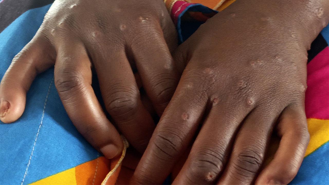 Für das Ende des Endes, wer den internationalen Notfall für MPOX beschreibt.
