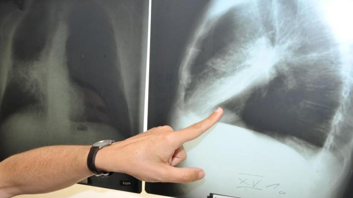 Diese Vitamine können das Problem der Lungu -Krankheit erhöhen
