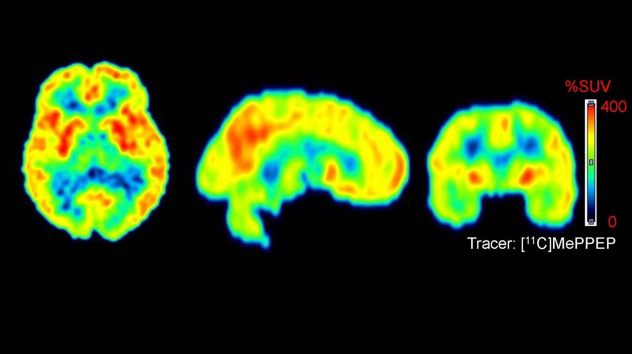 Forscher in Innsbruck zeigten erstmals die Wirkung von Cannabinoiden auf die Parkinson-Krankheit